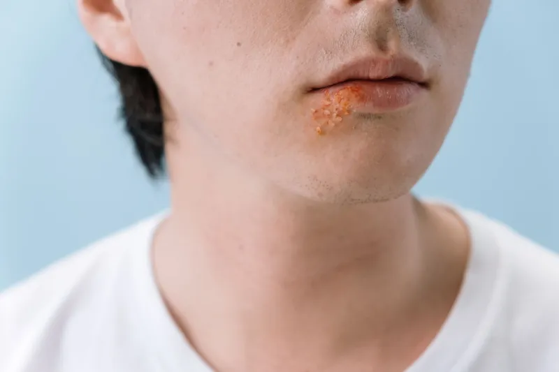 Aftas en la boca que no desaparecen: causas profundas y un protocolo de farmacia para cortar el ciclo de una vez